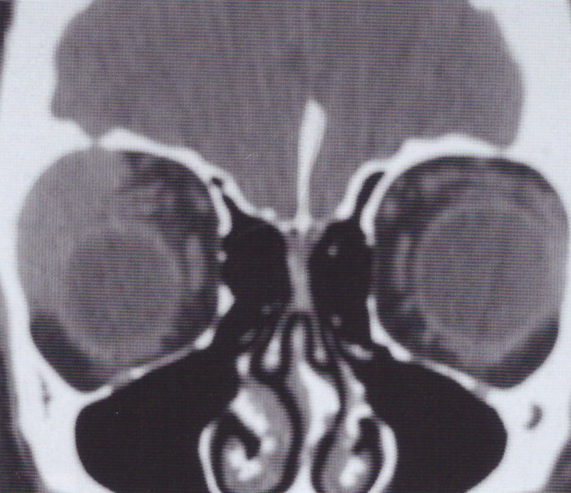 Αξονική τομογραφία δακρυοαδενίτιδας δεξιού οφθαλμικού κόγχου. Παρατηρείται διόγκωση του δακρυϊκού αδένα. 