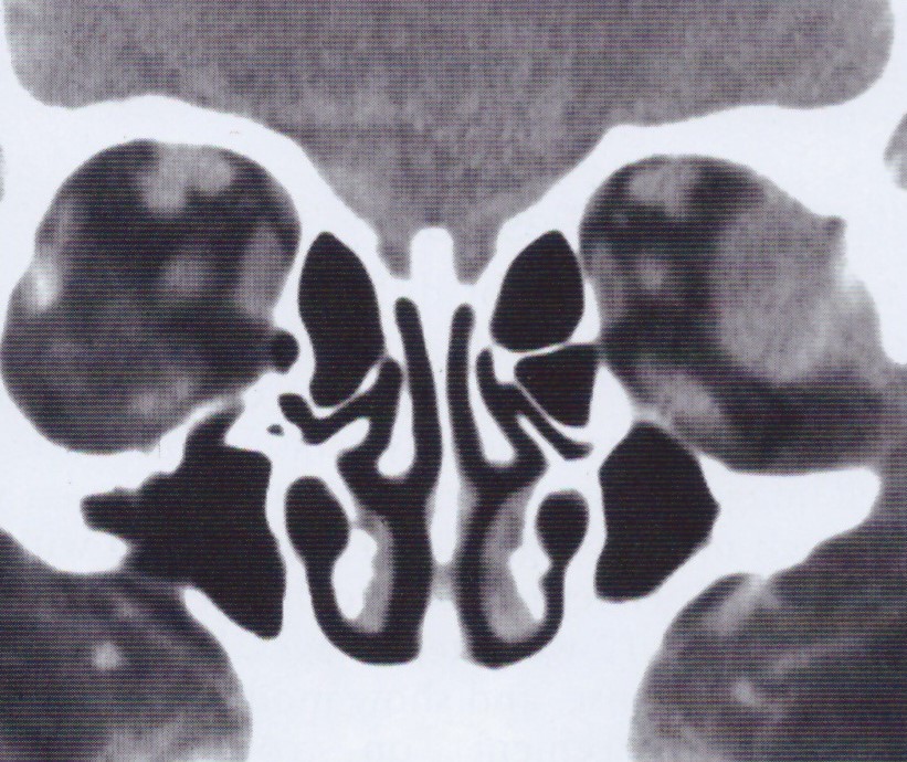 Αξονική τομογραφία μυοσίτιδας αριστερού οφθαλμικού κόγχου. Παρατηρείται πάχυνση του έξω ορθού μυός. 