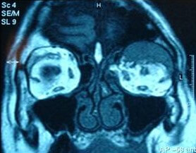 ΟΓΚΟΙ ΟΦΘΑΛΜΙΚΟΥ ΚΟΓΧΟΥ - Λέμφωμα αριστερού οφθαλμικού κόγχου. Μαγνητική τομογραφία.