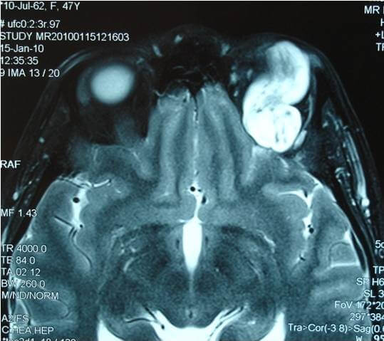 ΟΓΚΟΙ ΚΟΓΧΟΥ - Λέμφωμα αριστερού οφθαλμικού κόγχου. Μαγνητική τομογραφία.