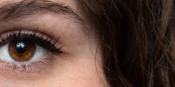Eyelid ptosis