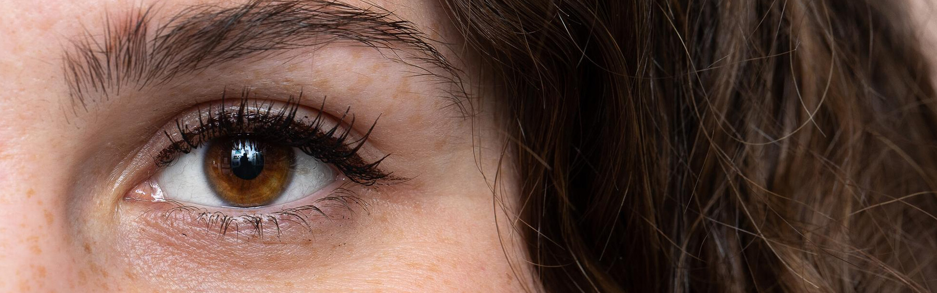 Eyelid ptosis 1 Eyelid ptosis