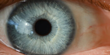 Thyroid eye disease