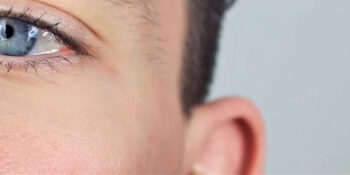 Nasolacrimal duct obstruction