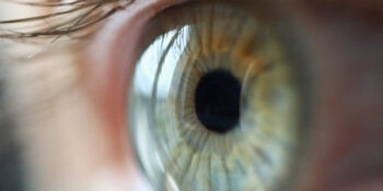 Ectropion
