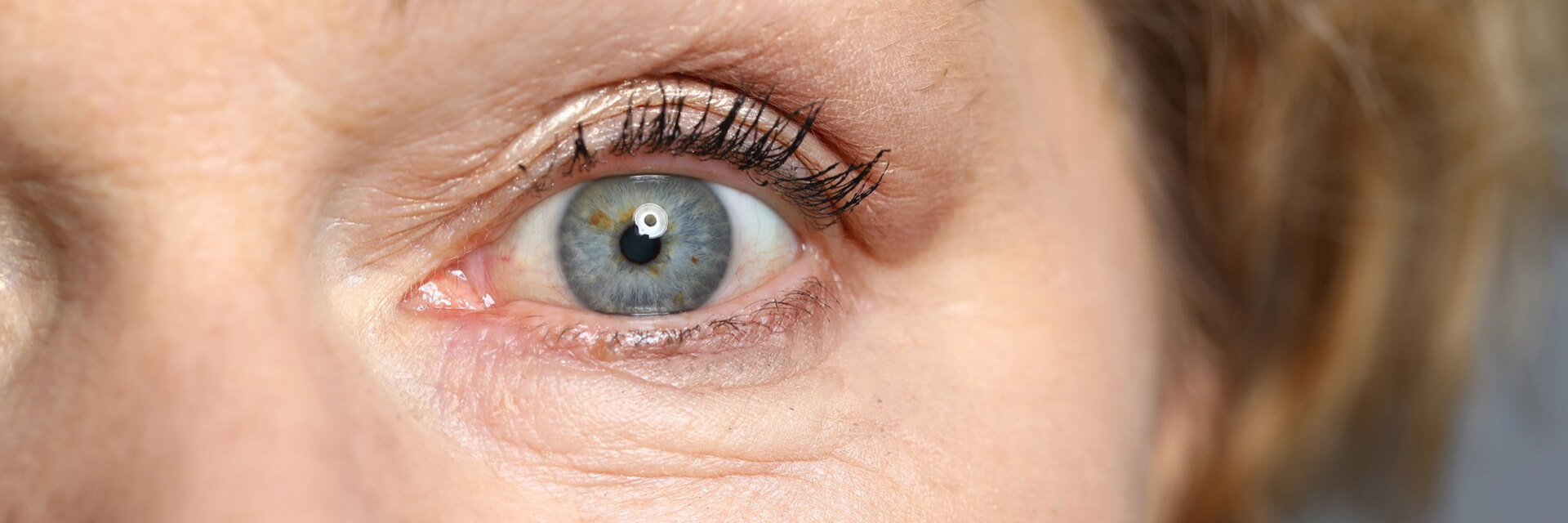 Trichiasis 2 trichiasis - eyelid diseases